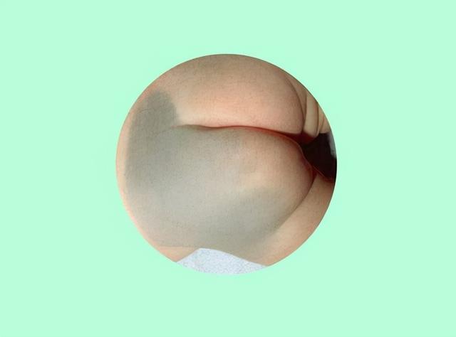 新生儿屁股有“淤青”是怎么回事？不是投胎时被踢，或与爸妈有关