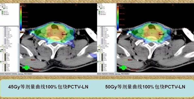 中国食管癌放射治疗指南 | 放疗适应症与放疗计划制定