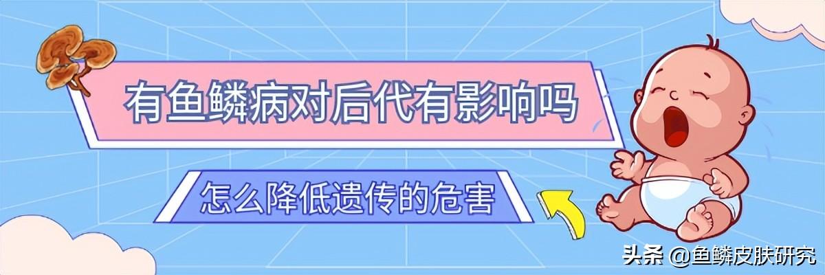 爸爸有鱼鳞病会遗传儿子吗
