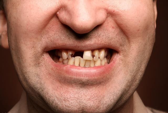 老年人多大岁数开始掉牙，一般来说，老年人多少岁才开始“掉牙”如何预防“老掉牙”