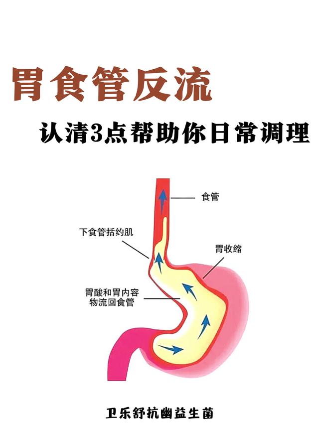 调理胃食管反流，你只需要记住这三个点