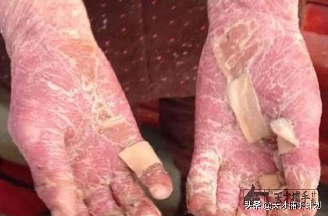 盖住鱼鳞病的身体乳
