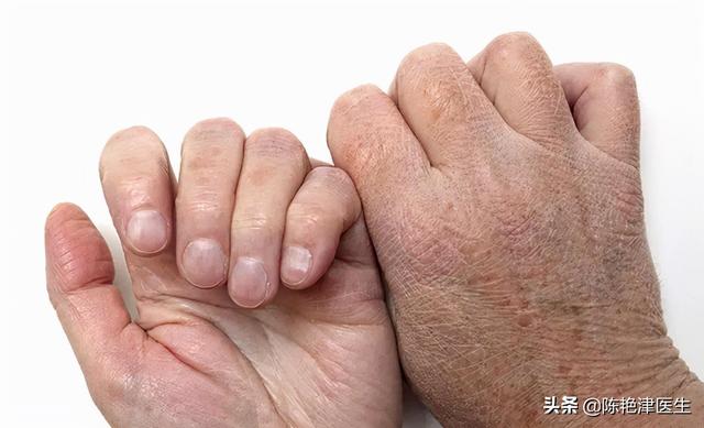 硫磺乳涂了4天身体还痒