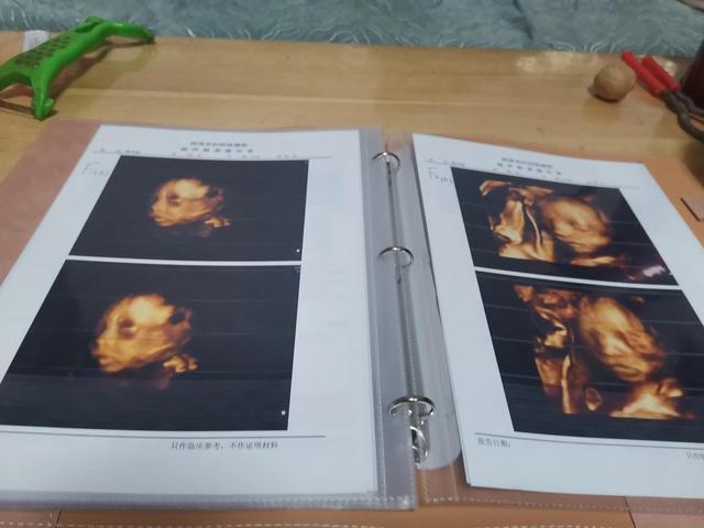 试管婴儿双胎 真期待两个小生命的降临