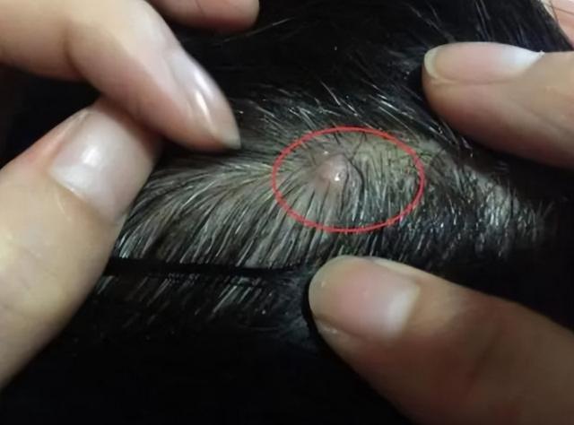 为什么头皮上经常长脓包和疙瘩？医生提示：3种病或要考虑在内