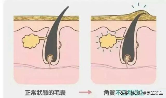 如何治鸡皮肤是什么样