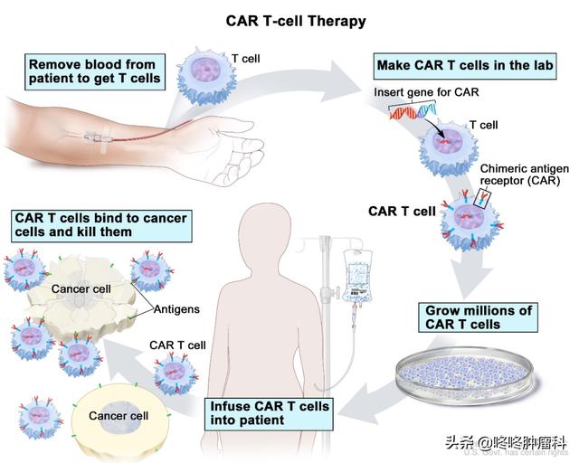 CAR-T治疗进军血液肿瘤一线方案！疗效惊艳完全缓解率达78%