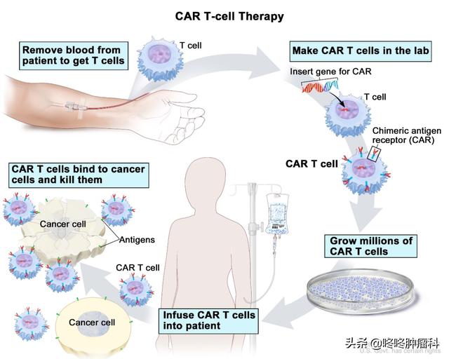 CAR-T治療進軍血液腫瘤一線方案！療效驚艷完全緩解率達78%