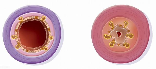 急性气管支气管炎预防与护理
