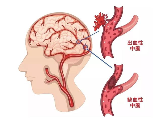 血压高到多少才会发生脑出血？医生给出参考值，建议心里有数