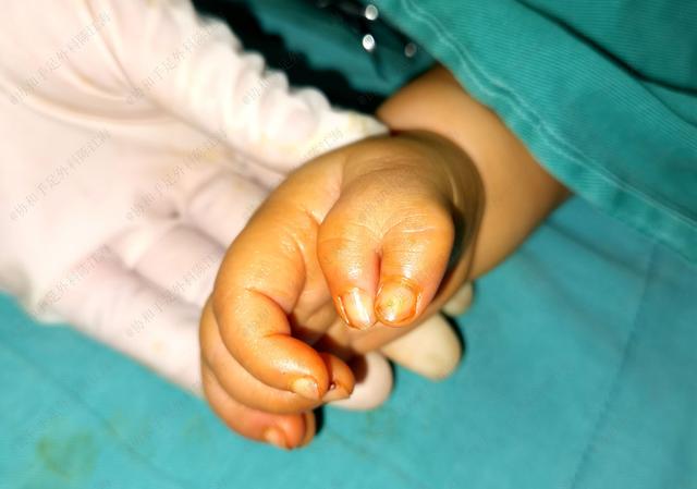 多指手术几个月后，孩子哭个不停，妈妈扳开宝宝手后立马送进医院