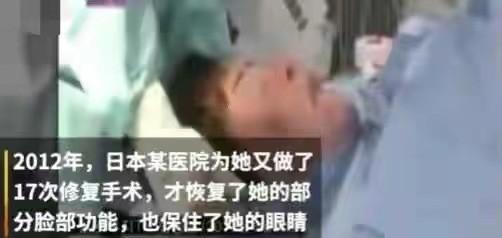 韩慧景：把自己整成“电风扇”，注射食用油代价惨痛，我悔不当初
