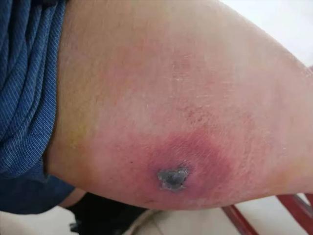 想要户外踏青不受蚊虫叮咬，你需掌握这几点，守护肌肤第一道防线