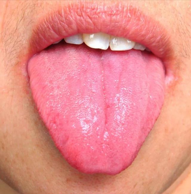 舌象分析，看看正常的和异常的舌象对比