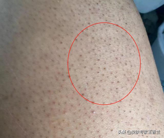 怎样除掉脸上的鸡皮肤