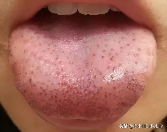 瘀血的识别与调理方法