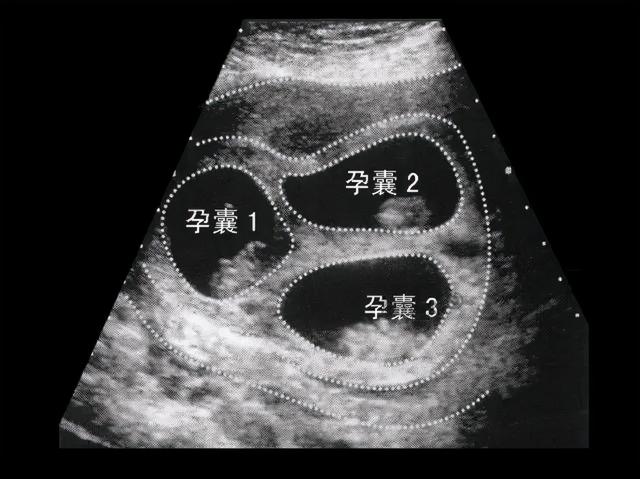 河南怀八胞胎女子说想保留四五个，这可行吗？