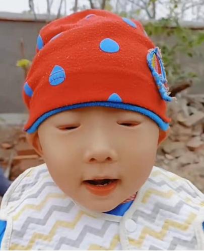 五年八部曲，上睑下垂分阶段治疗的故事