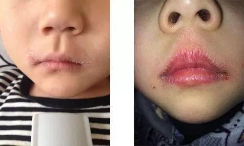 冬季来临，婴幼儿进入口角炎的高发季，医生：3点原因，点破真相