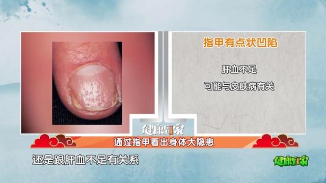 手指甲满足3个特点，多半是身体在“求救”！赶紧自测