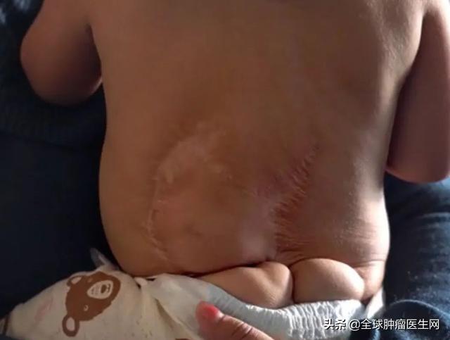 淚目！還未出生就確診癌癥，“傳奇”藥物讓最小的戰士擊敗腫瘤