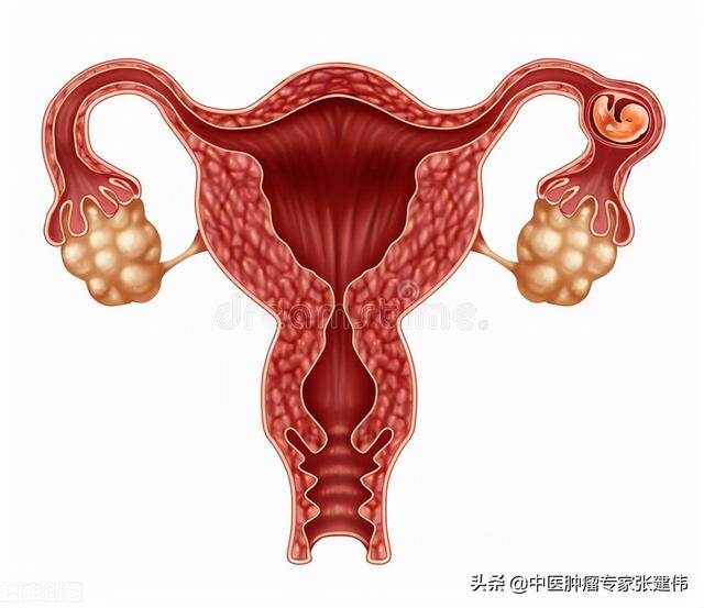 以为“月经不调”是小事，一查竟是卵巢癌！这几个信号别忽视