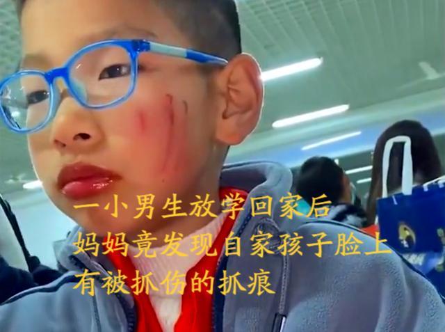 苏州男孩被同学抓伤脸，妈妈的反应令人称赞，网友：明事理的妈妈