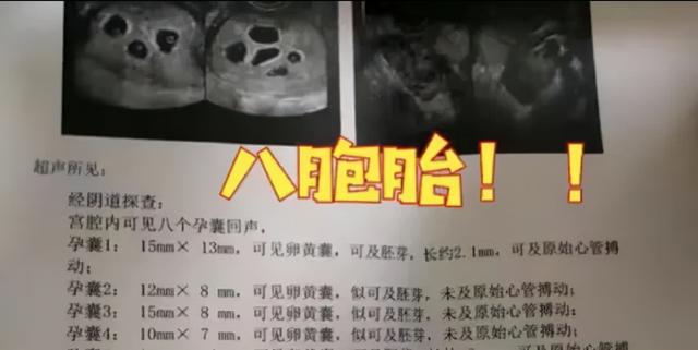 2.7亿人围观郑州孕妇怀8胞胎，医生说太危险了，为何这么多？