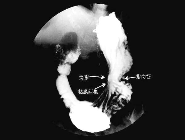 胃在什麼位置圖片胃在什麼位置圖片示意圖