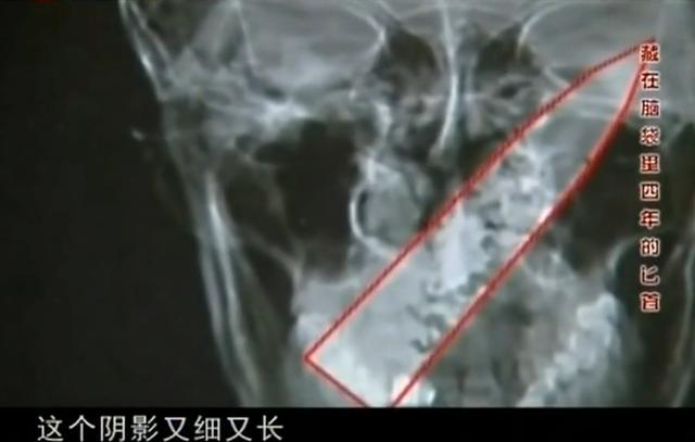 11年云南男子头疼呕吐，身上散发臭味，检查发现脑中插着一把匕首