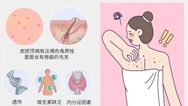 针对鸡皮肤的润肤