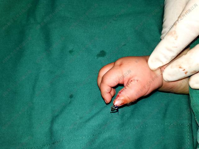 多指手术几个月后，孩子哭个不停，妈妈扳开宝宝手后立马送进医院