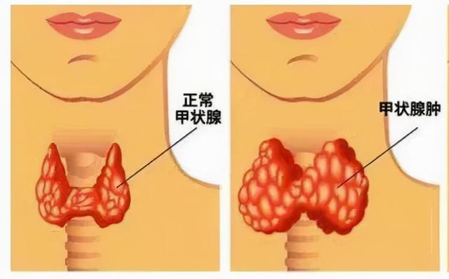 优甲乐效果虽然好，但是要警惕这五个不良作用，要重视