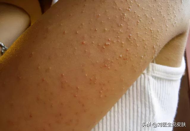 为什么有的皮肤是鸡皮