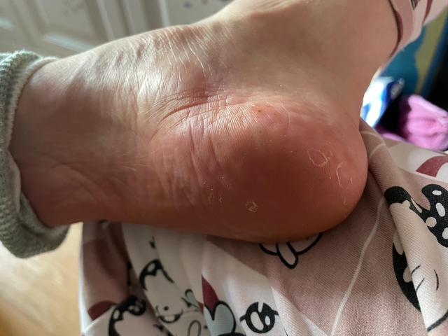 角化字足癣能治好吗