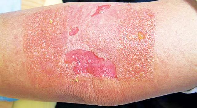 皮肤局限性角化亢进