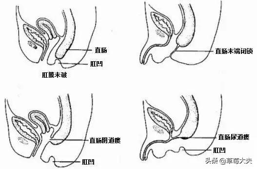 出生无肛门，肚子气球大！“气球宝宝”在草莓医院挺过来了