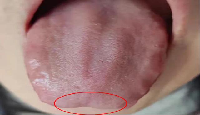 气虚怎么补？通过舌象告诉你如何精准参考中成药，学会不走弯路
