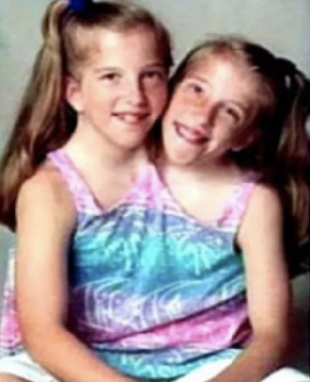 两个大脑指挥一个身躯，真的能保证不吵架吗？连体婴生活大揭秘