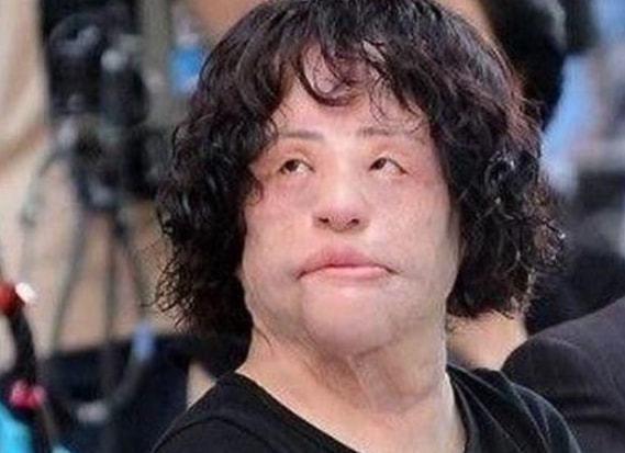 韩慧景：把自己整成“电风扇”，注射食用油代价惨痛，我悔不当初