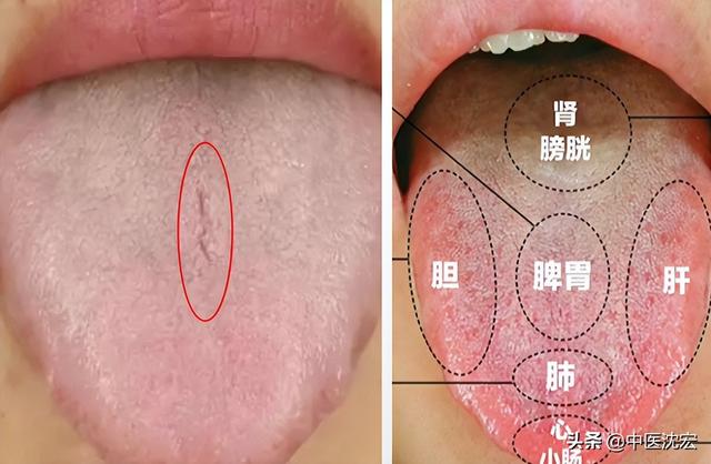 舌头有裂纹，究竟是身体出了什么问题？今天沈医生一次给你讲明白