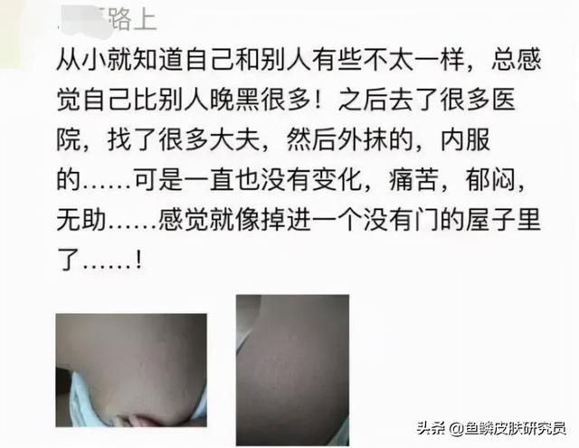鱼鳞病有人治好的吗