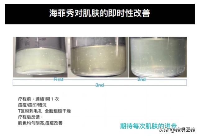 医美无平替!4个小众贵妇级轻医美项目,谁做谁说值