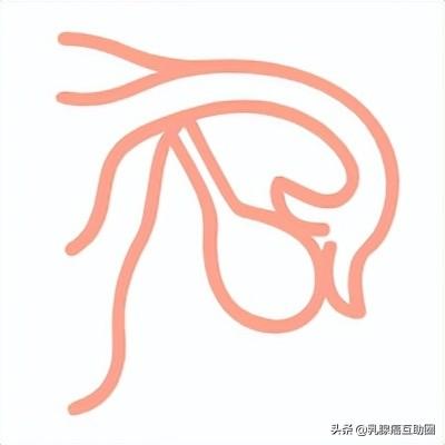 警惕！得了乳腺癌，患其他癌的風險增加20%