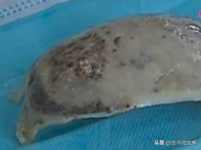 聪明小孩变傻痴，多年后才发现他脑袋里长了个大贝壳，怎么回事？