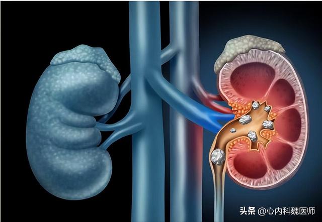 男子吃降压药10年，发生肾衰竭！医生：他犯了3个错误，值得反思