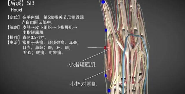 后溪穴—急性扭伤腰痛