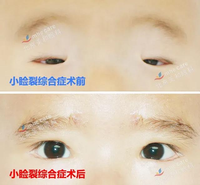 五年八部曲，上睑下垂分阶段治疗的故事