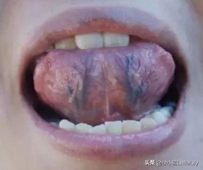 瘀血的识别与调理方法