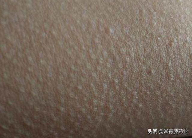 鸡皮肤比较厉害跟内分泌有关系么